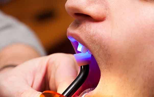 Dentist hardening resin with dental light