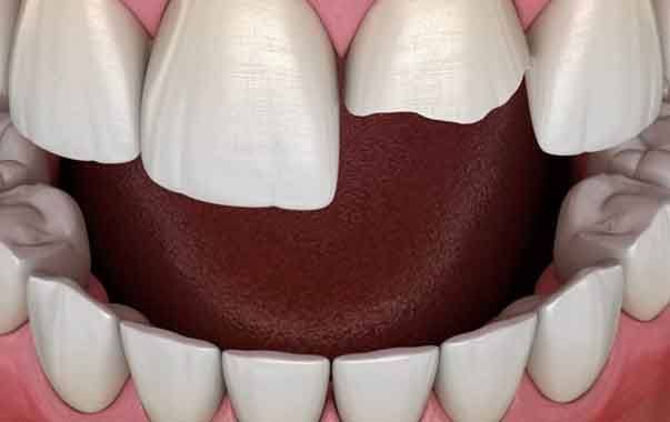 Model of a chipped front tooth