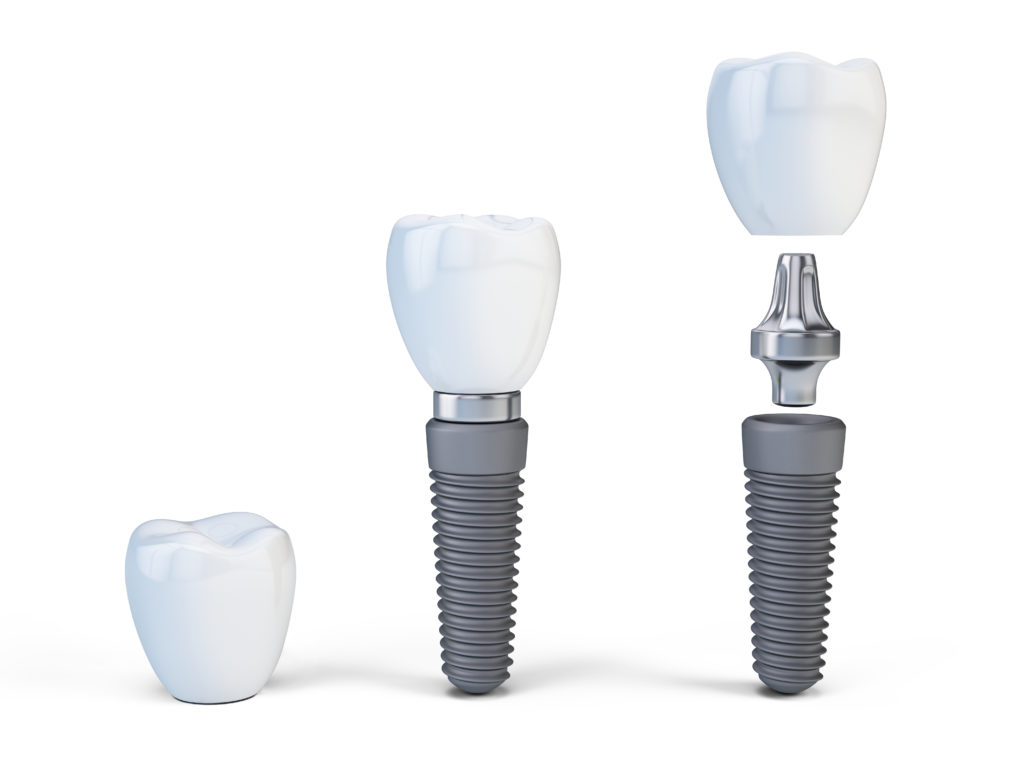 The Differences Between Mini and Regular Dental Implants